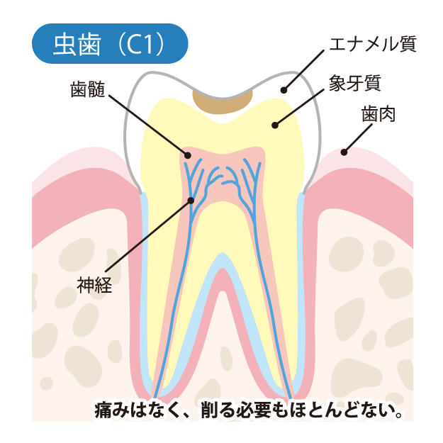 富士市（静岡）の歯医者でむし歯治療