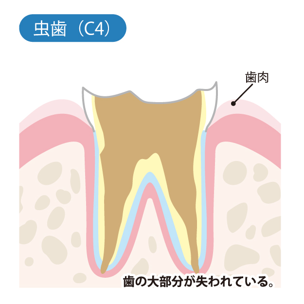 富士市（静岡）の歯医者でむし歯治療